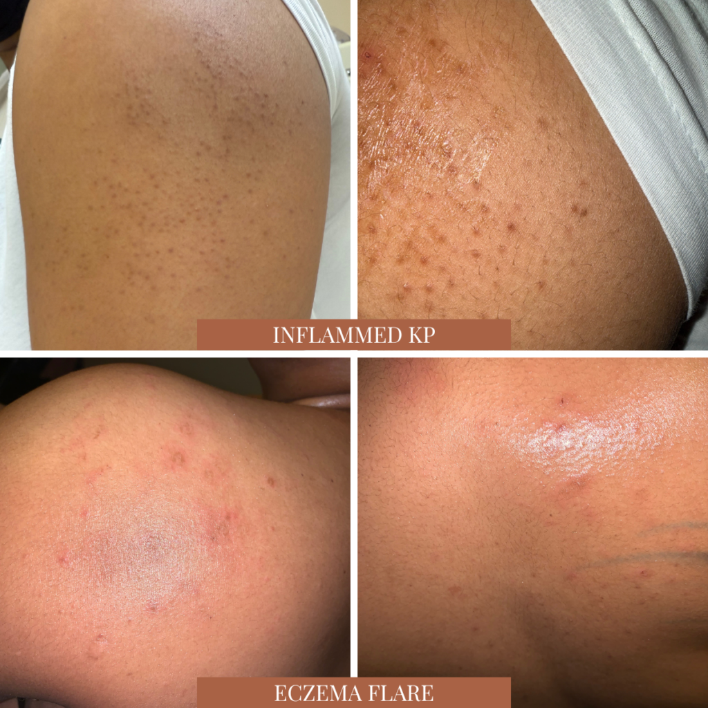 Collage showing inflamed keratosis pilaris (KP) on the upper arm and an eczema flare on the upper back prior to incorporating a 10% urea moisturizer into my skincare routine.
