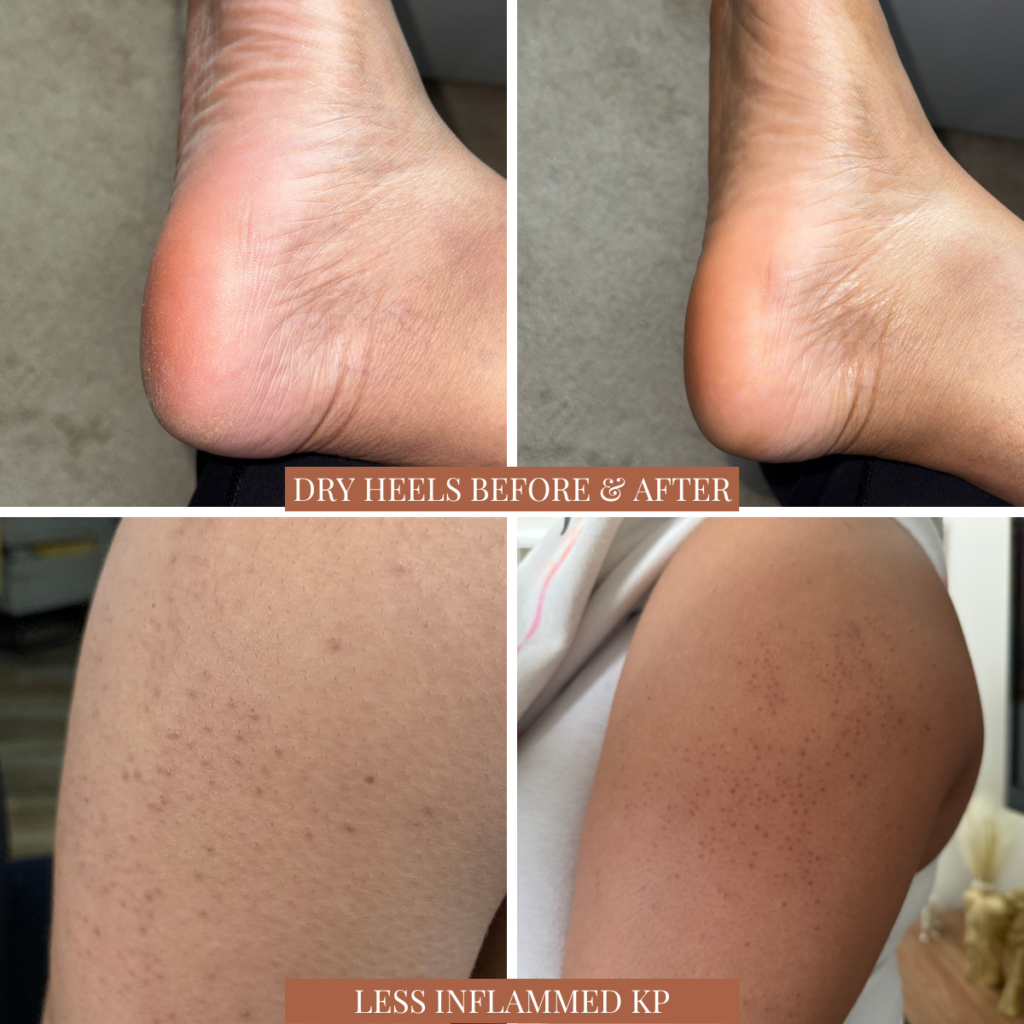 Before-and-after comparison showing improvements in dry heels and keratosis pilaris (KP) texture after incorporating a 10% urea moisturizer into a consistent skincare routine.
