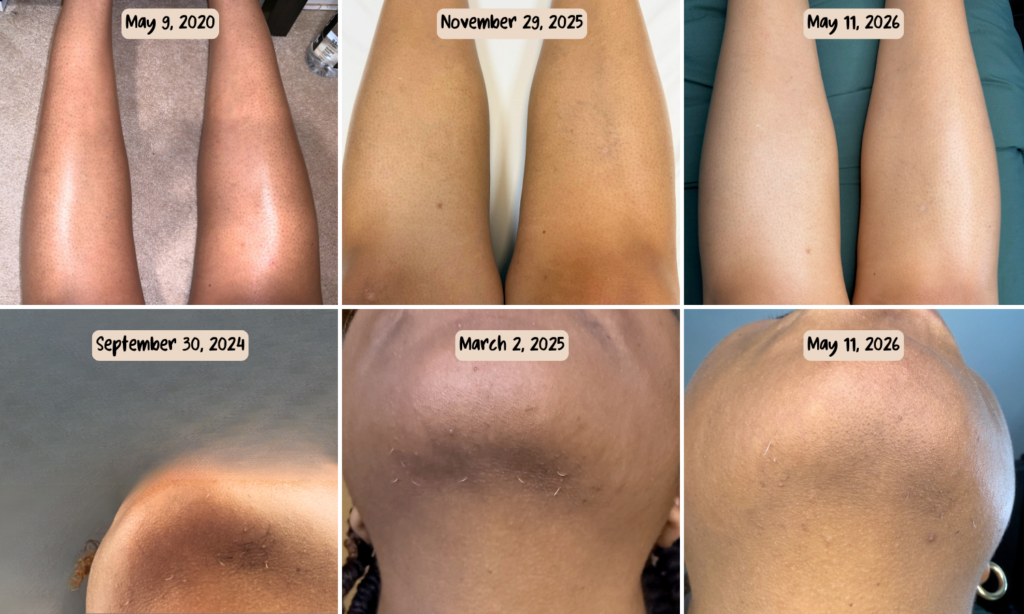 Progress photos showing improvement in Keratosis Pilaris and hair reduction after laser hair removal treatments at Milan Laser from 2020 to 2026