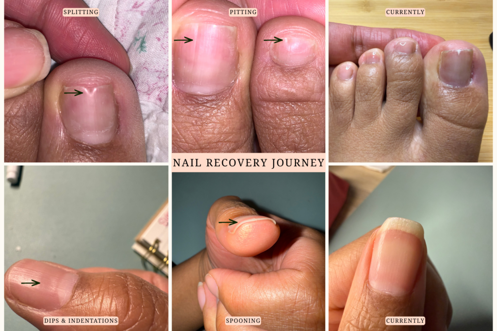 Photos documenting my nail recovery journey, including splitting, pitting, dips, indentations, and spooning, compared with more recent images showing improved nail health and growth.
